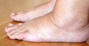 Zanurz stopy, by pozbyć się opuchlizny. Szklanka octu wystarczy