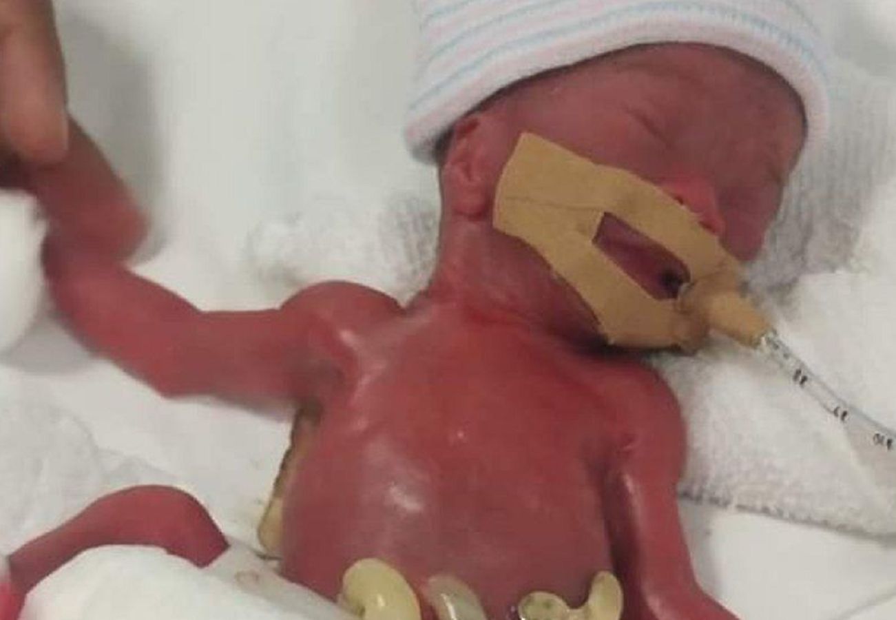 "Najmniejsze niemowlę świata" wypisane do domu. Spędziło w szpitalu 13 miesięcy