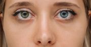 Kolor oczu może świadczyć o chorobie. Nie lekceważ tych zmian