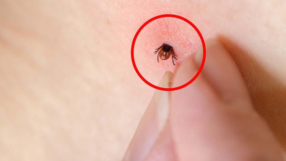 Po tym rozpoznasz, że ugryzł cię zakażony kleszcz. Objawów jest kilka