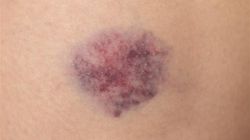 Pojawił się bez uderzenia? Chirurg tłumaczy, czego to może być objaw