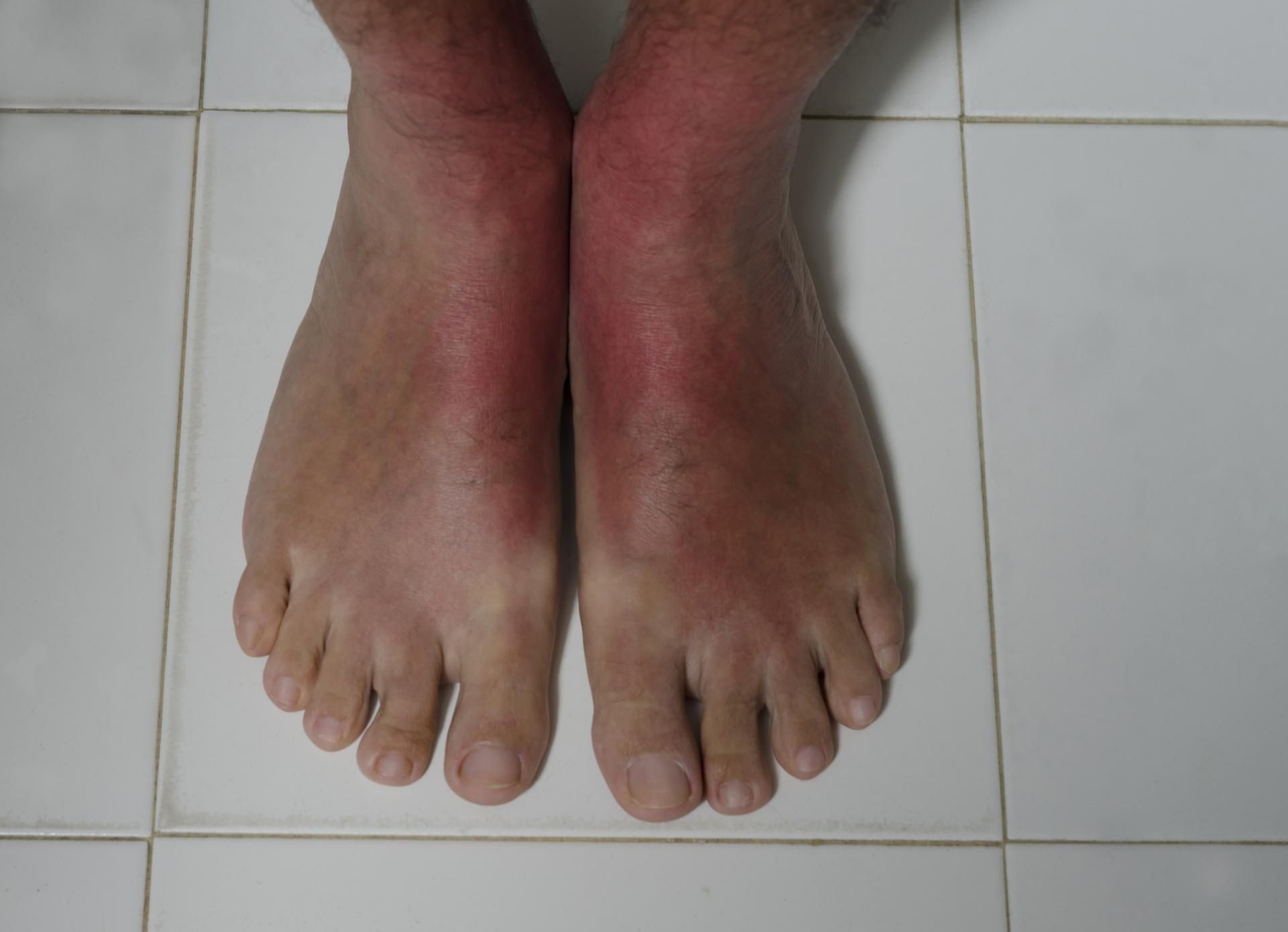 Promieniowanie UV to najważniejszy czynnik rozwoju ryzyka wszystkich nowotworów skóry