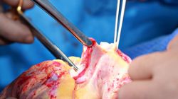 4 osoby zmarły na raka piersi. Połączył ich wspólny dawca