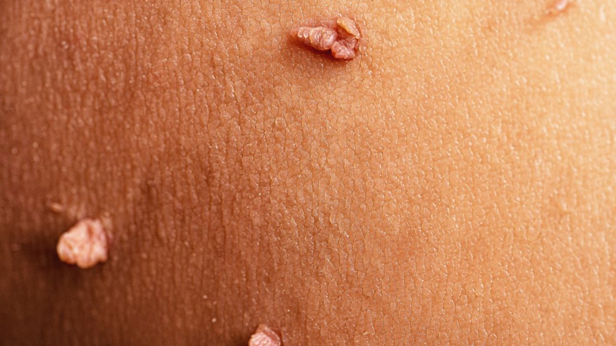 Usuwanie włókniaków zwykle nie jest zabiegiem koniecznym, wykonywanym ze wskazań medycznych.