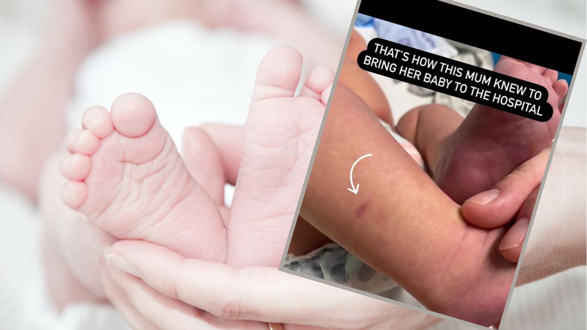 Czerwony ślad na skórze dziecka może wieszczyć niebezpieczeństwo