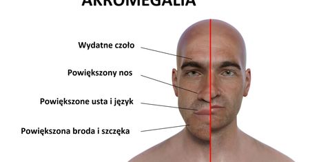 Gigantyzm - przyczyny, objawy, leczenie