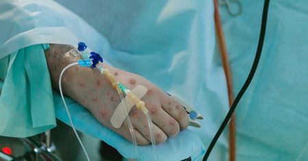 Nowy szczep wirusa mpox zbiera śmiertelne żniwo. Takie są objawy