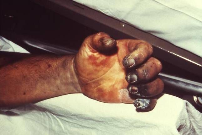 9 najgroźniejszych epidemii w historii ludzkości 3