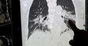 Koronawirus. Niepokojące doniesienia z Austrii. Nawet łagodny przebieg może niszczyć płuca