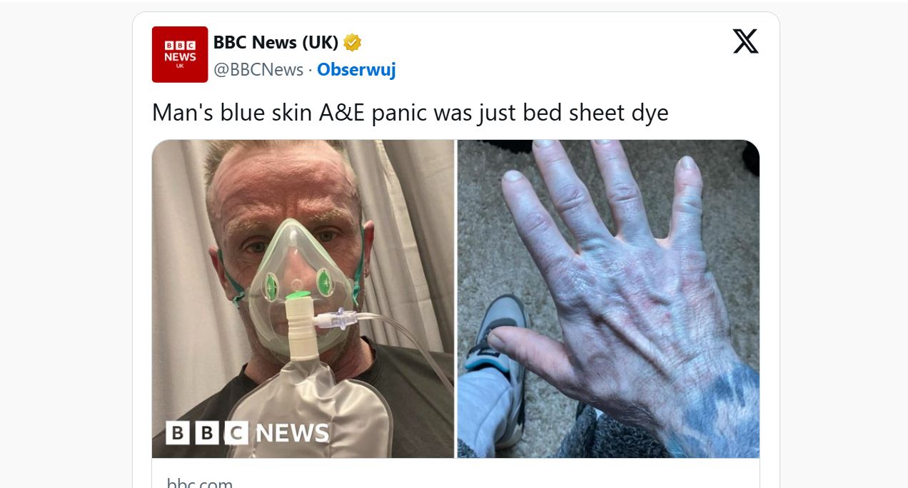 Tommy Lynch trafił na SOR z niebieską skórą