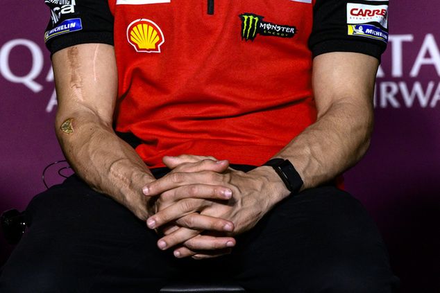 Tak wygląda złamana przed laty prawa ręka Marca Marqueza