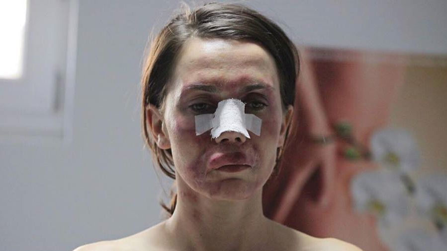 Co o "Botoksie" sądzą lekarze? Sprawdziliśmy