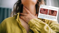 Ta rzadka choroba ma związek z HPV. FDA zatwierdza pierwszy lek