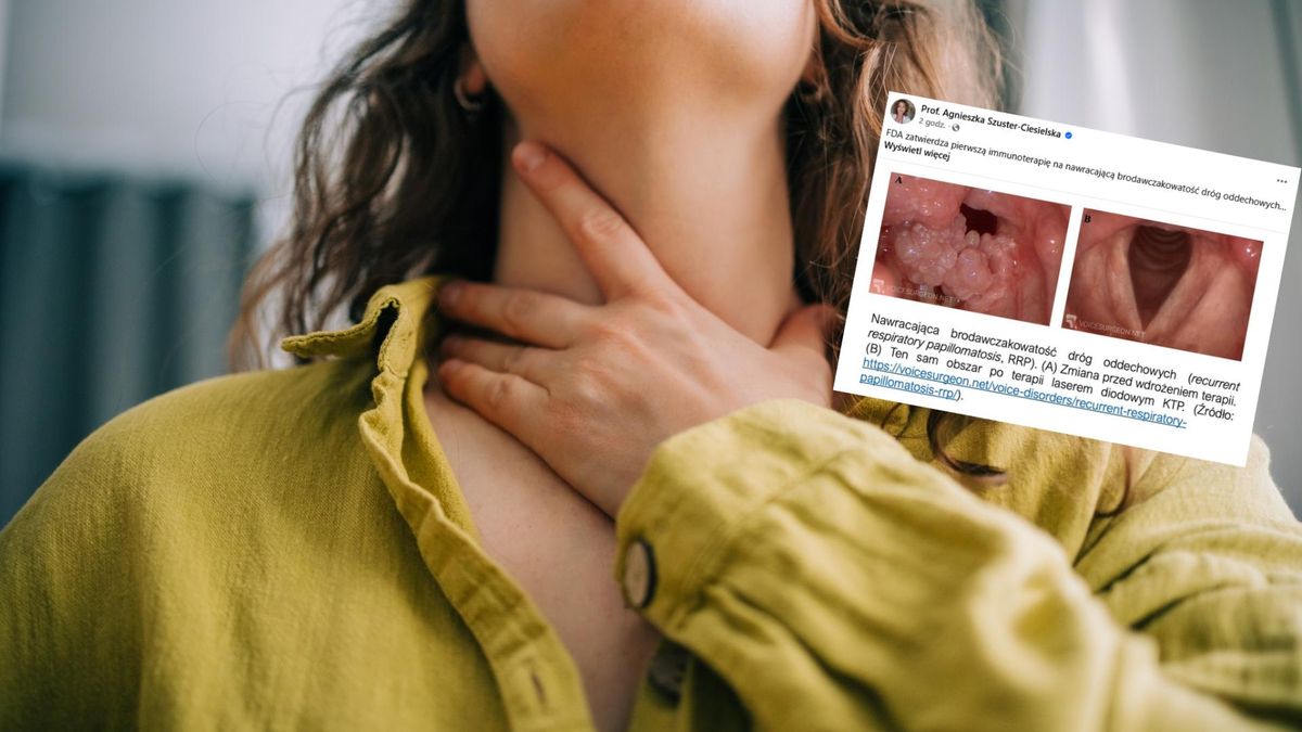 Nawracająca brodawczakowatość dróg oddechowych to rzadka, przewlekła choroba