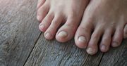 Wysoki cholesterol. Jego objawy mogą pojawić się na paznokciach u stóp
