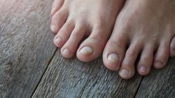 Wysoki cholesterol. Jego objawy mogą pojawić się na paznokciach u stóp  