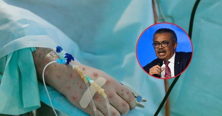 WHO o małpiej ospie. Ogłoszono ważną decyzję
