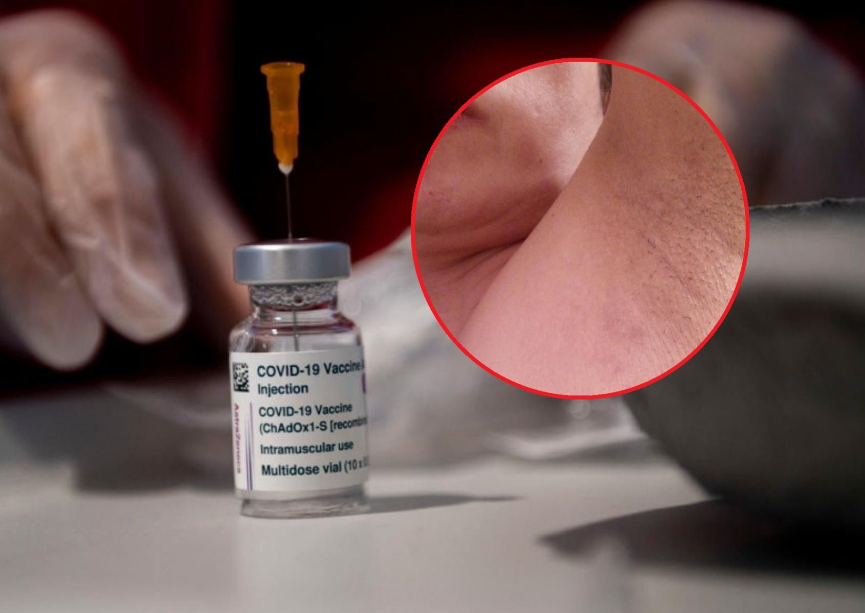 Powiększone węzły chłonne pod pachami objawem poszczepiennym