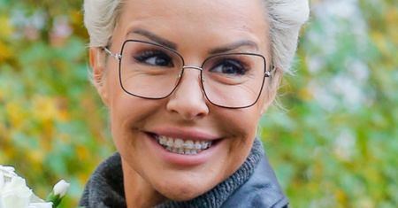 Blanka Lipińska z twarzą NAKŁUTĄ IGŁAMI  raduje się po kolejnym zabiegu: "NACIĄGNĘŁAM SIĘ" (FOTO)