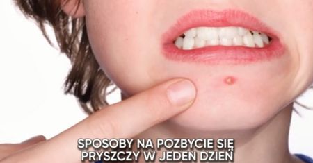 Jak zlikwidować pryszcze w jeden dzień? (WIDEO)