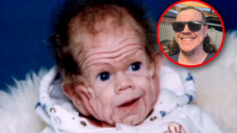 Niemowlak, który wyglądał jak staruszek. Tak wygląda 30 lat później