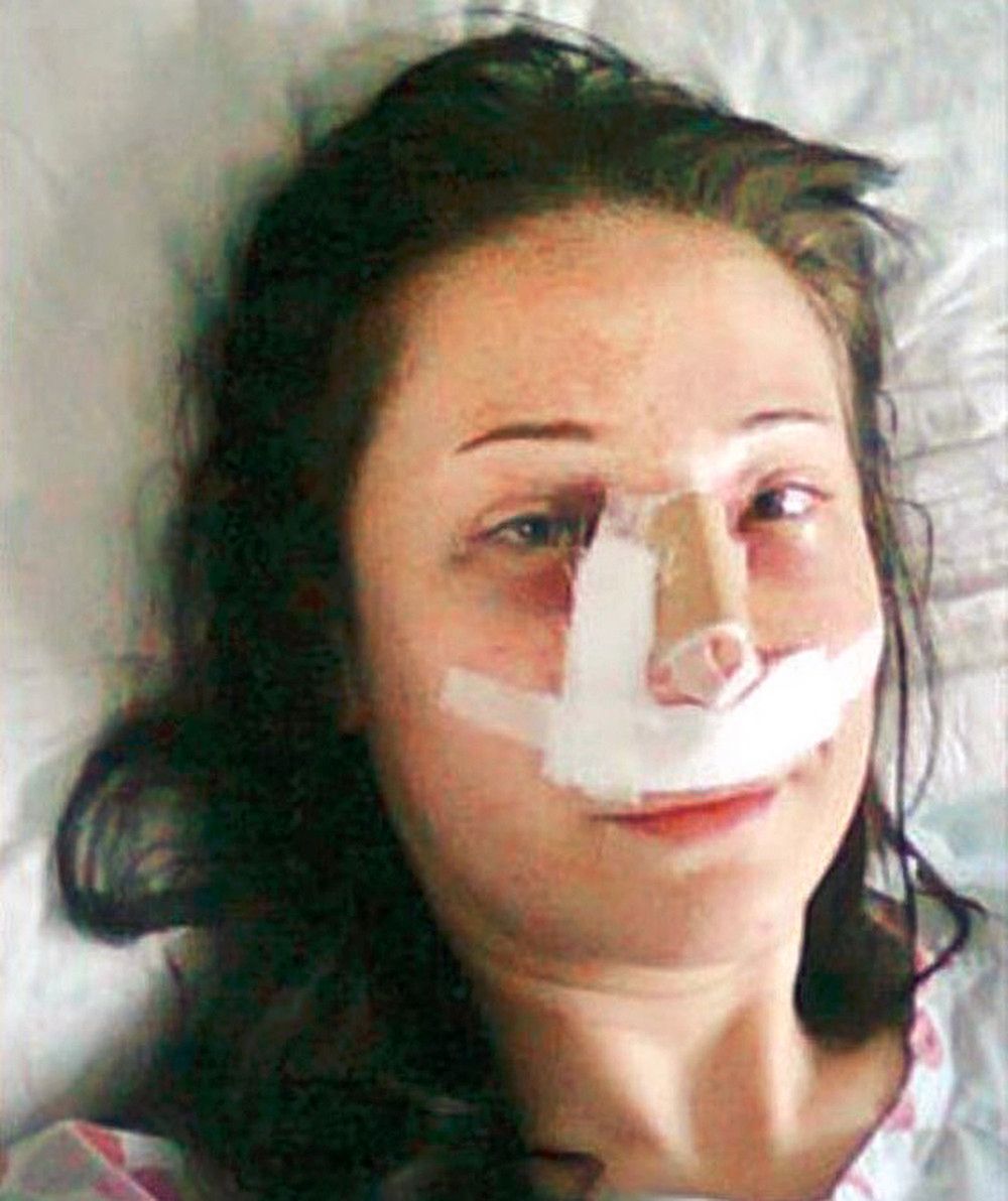 Sevinc Ceklik zaraz po zabiegu korekty plastycznej nosa