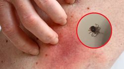 Coraz więcej Polaków z boreliozą. Wybierają niebezpieczną metodę leczenia