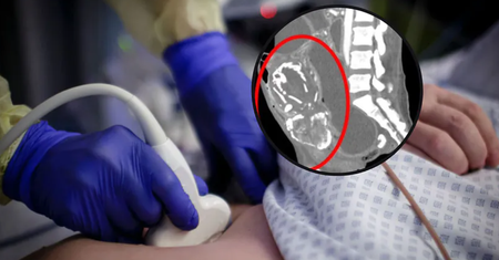 Przez 9 lat nosiła "kamienne dziecko". Uważała, że to klątwa