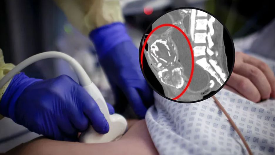 Przez dziewięć lat nosiła "kamienne dziecko"