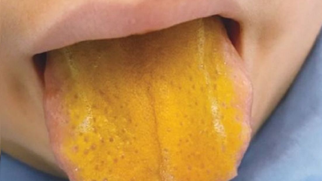 Język chłopca zrobił się jasnożółty.