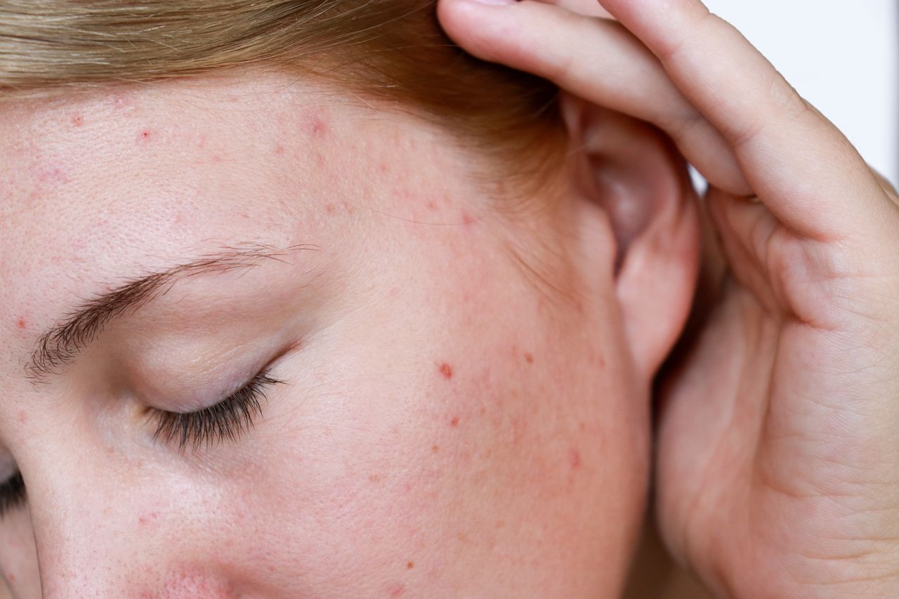 How to get rid of pimples?