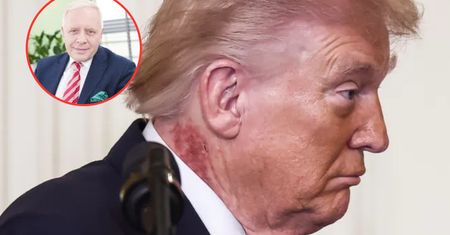 Zmiany na szyi Trumpa. Co oznaczają?