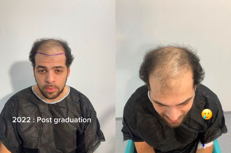 Przeszczepił włosy w Turcji. Oto jego historia