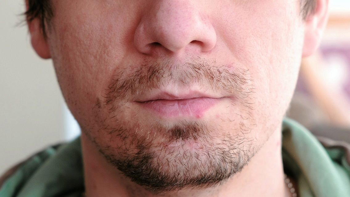 Naukowcy udowodnili, że zakażenie wirusem Epsteina-Barr zwiększa ryzyko stwardnienia rozsianego