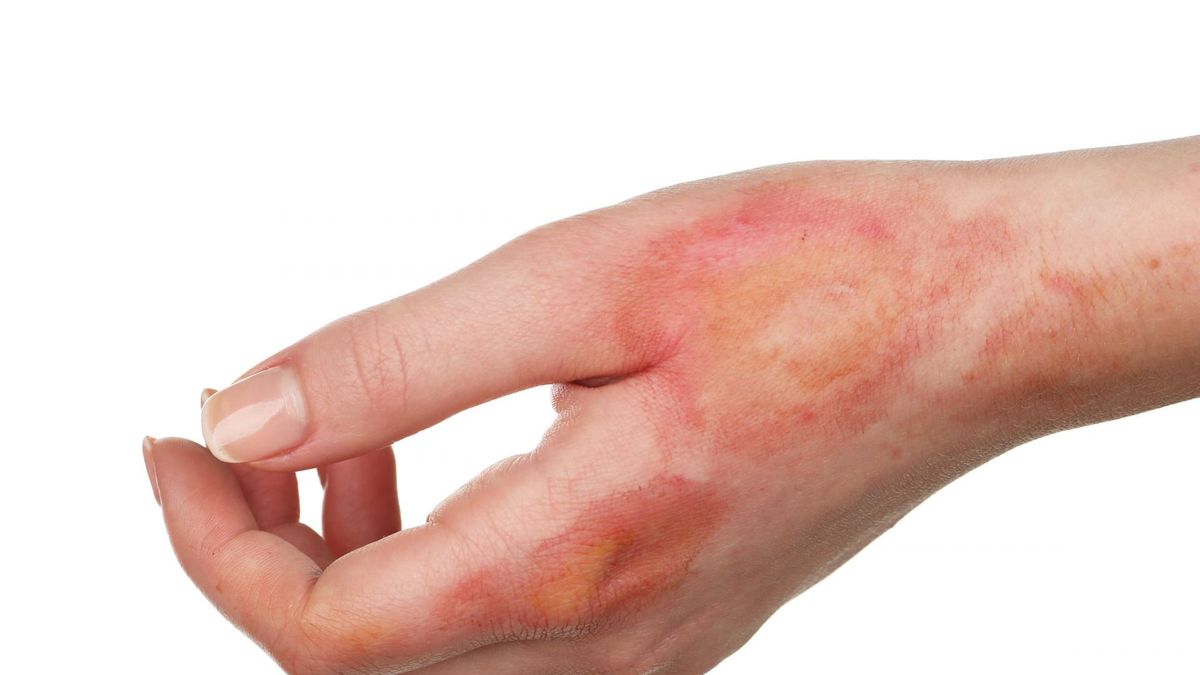 Oparzenia 2 stopnia mogą pojawiać się na skutek kontaktu skóry z gorącymi płynami, przedmiotami, ogniem, źródłami ciepła.