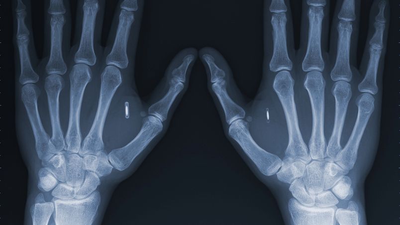 Nosiciele HIV w Indonezji będą "tagowani" chipami RFID? 1