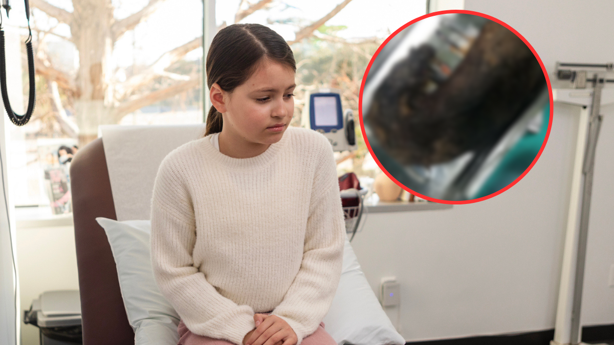 Lekarze byli w szoku. W żołądku 9-latki  znaleźli prawie kilogram włosów