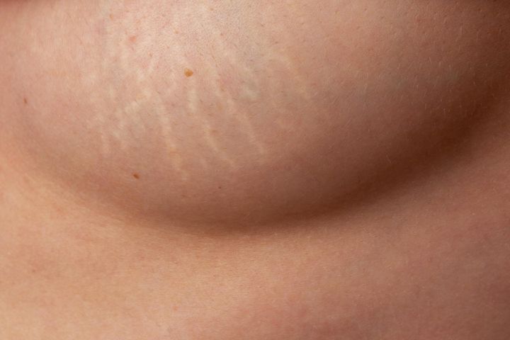 Rozstępy na piersiach to wrzeciownowate pręgi, pojawiające się na skórze wskutek zerwania włókien kolagenowych