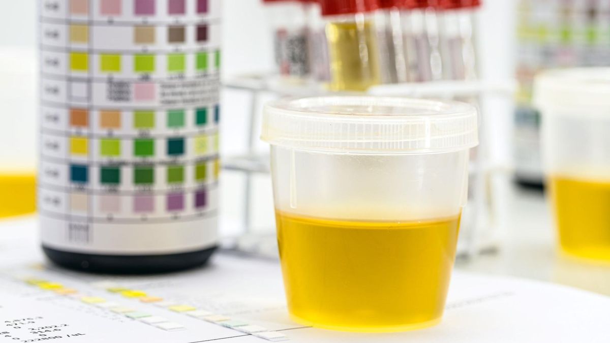 Zespół nerczycowy jest wieloobjawowym schorzeniem, który niesie za sobą groźne powikłania.