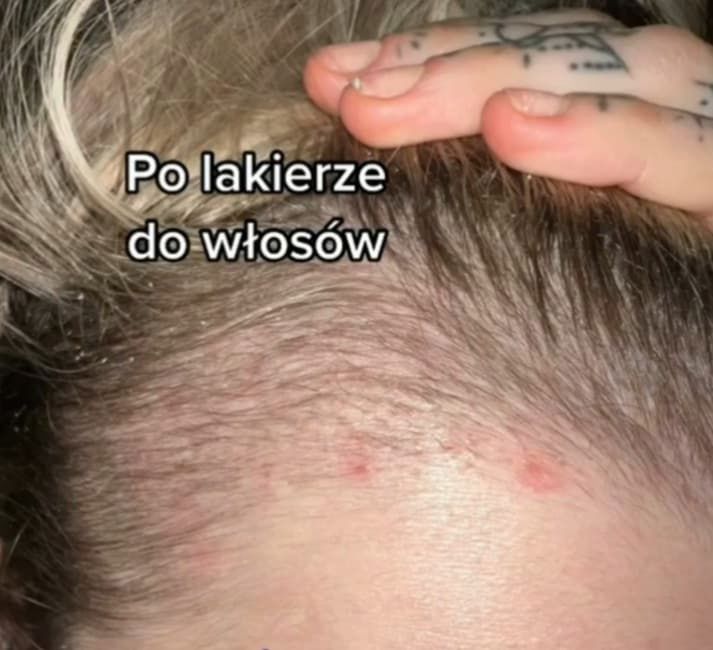 Monika Miller przeszczepiła włosy