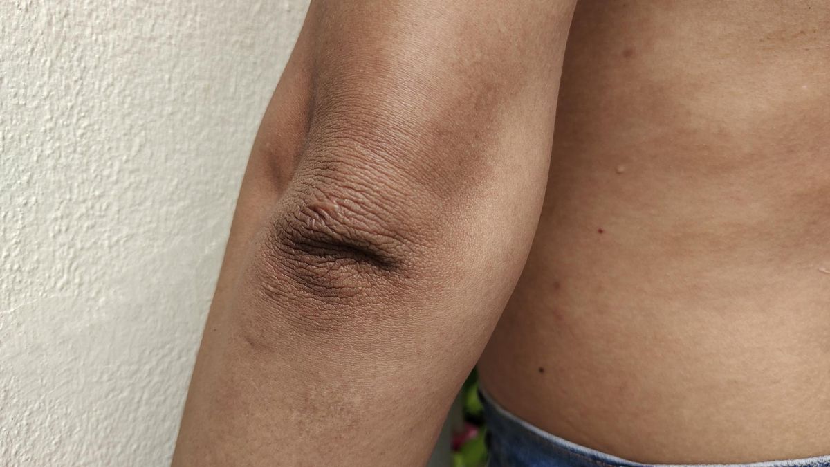 Brudne łokcie i kolana? Objawy chorej tarczycy