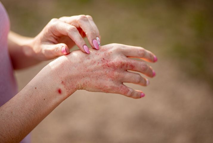 Atopowe zapalenie skóry jest niezwykle powszechną przewlekłą, zapalną, ale co ważne niezakaźną chorobą skórną.