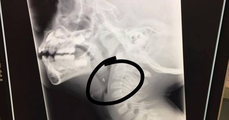 Wypadek na rodzinnym grillu. Chłopiec połknął kawałek metalowej szczotki