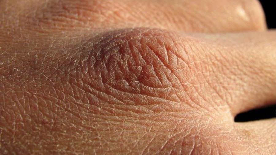 Objawy chorej tarczycy widać na skórze