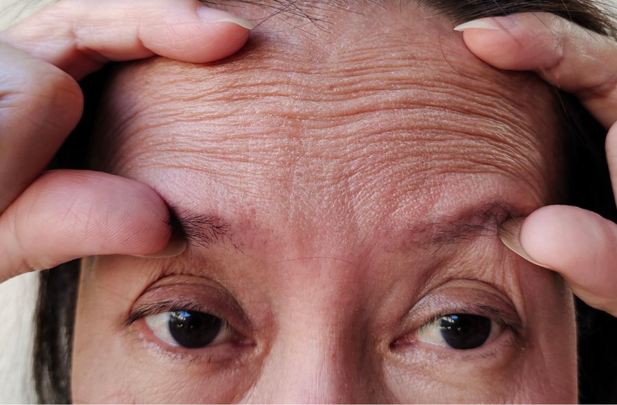 Why young people can have more wrinkles than elderly individuals? 