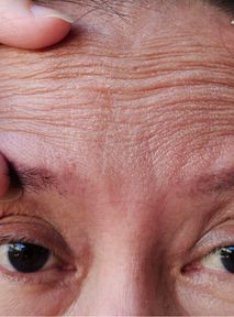 Why young people can have more wrinkles than elderly individuals?