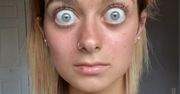 Naprawdę ma takie oczy. Sugerują chorobę, lecz przyczyna jest inna
