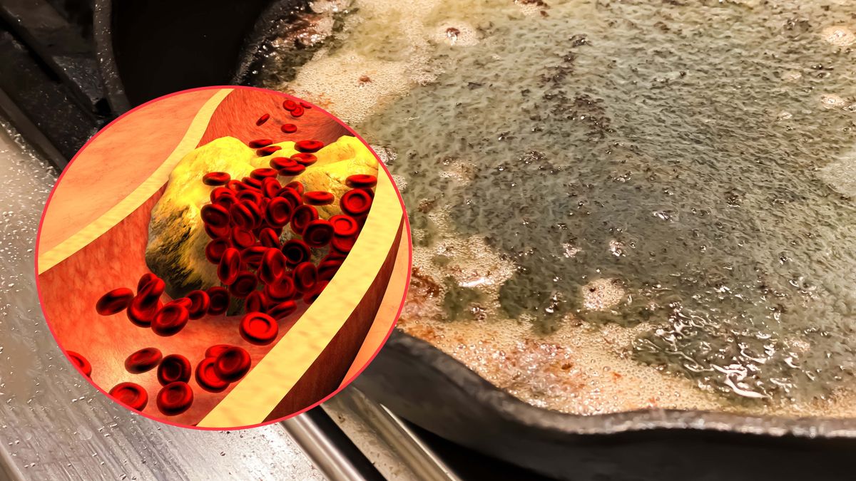 Odkładający się cholesterol LDL sprawia, że blaszek miażdżycy jest więcej - mogą dowadzić one do zawału serca oraz udaru mózgu