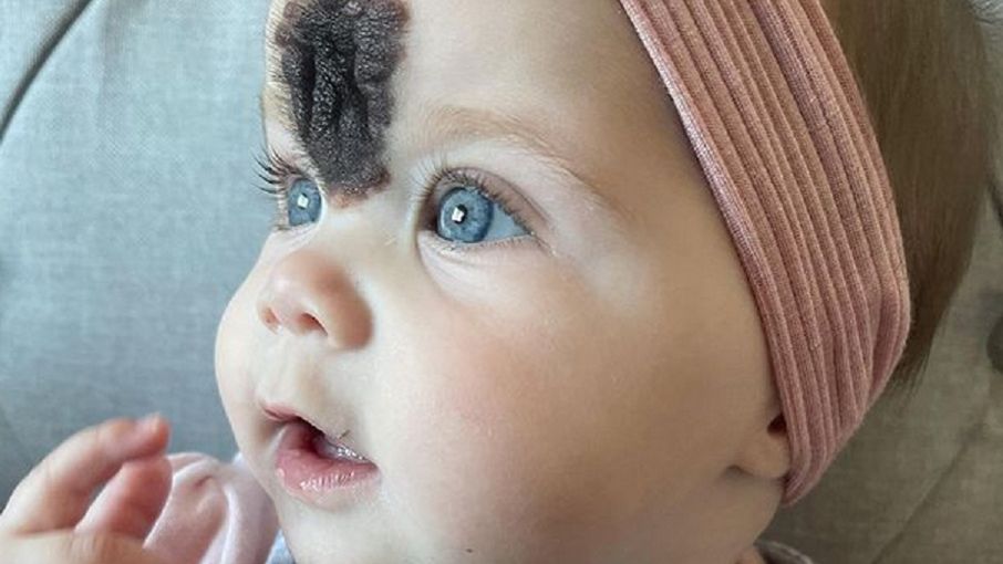 Urodziła się z czarnym znamieniem na twarzy. Lekarze nie chcieli go usunąć