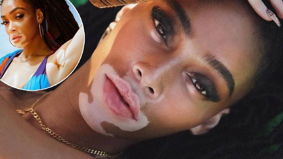 Winnie Harlow obchodzi urodziny.